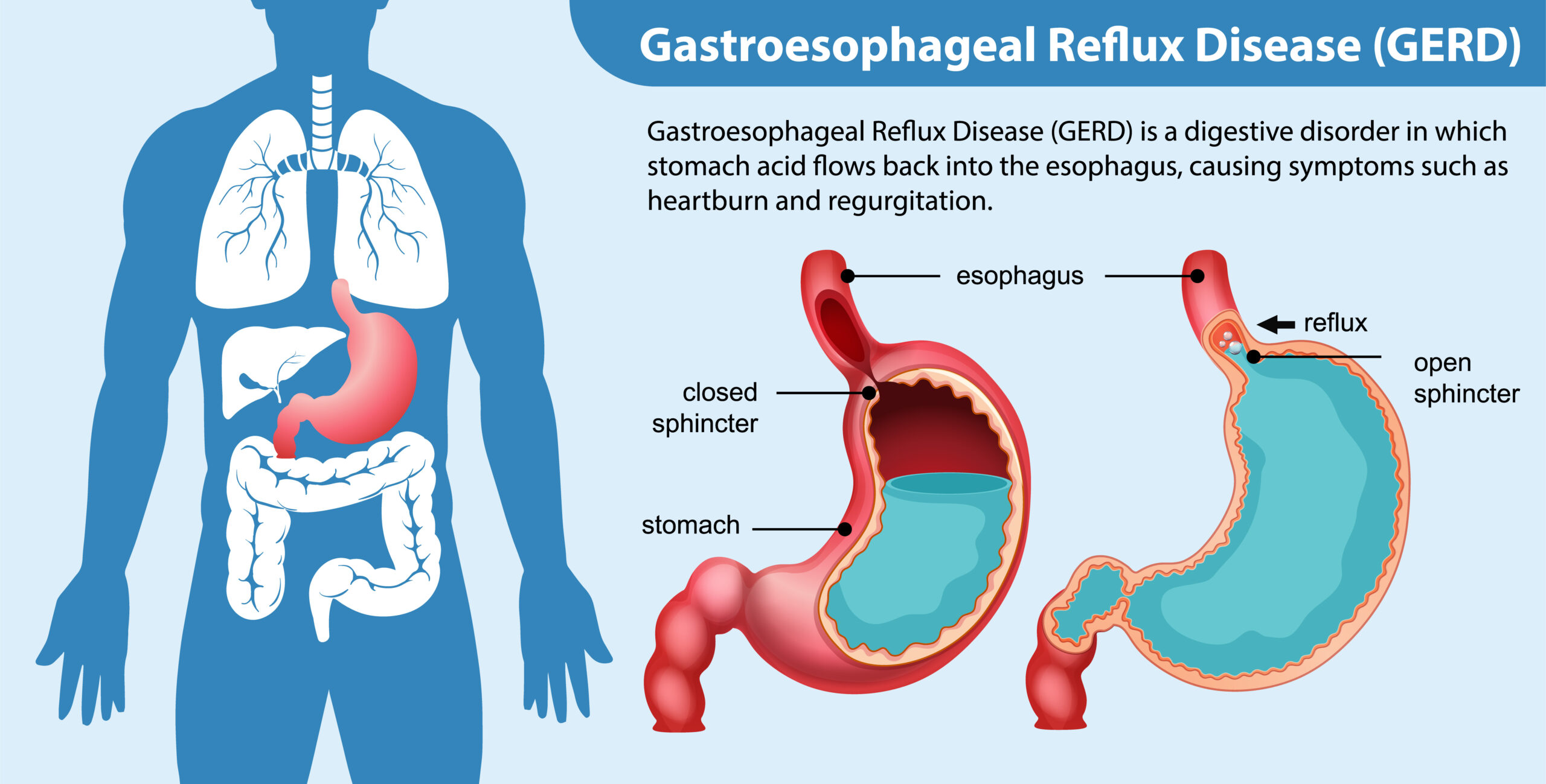 Gastroesophageal Reflux Disease (GERD) Diagram