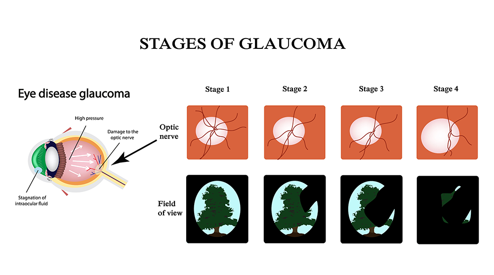 glaucoma-infographic