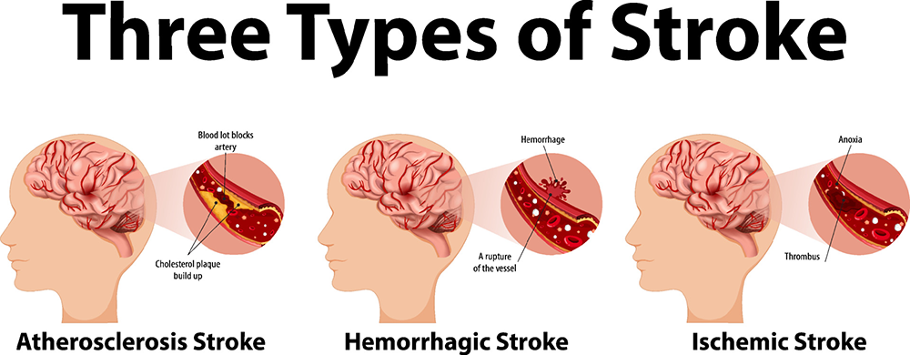 stroke-infographic