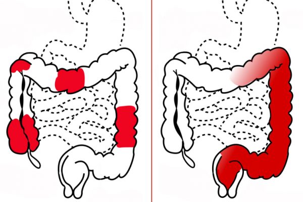 crohns_disease_vs-_ulcerative_colitis